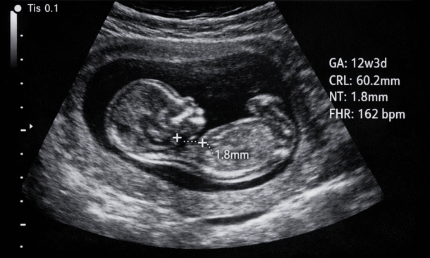 12-Week Ultrasound Scan