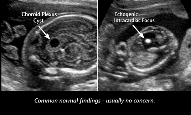 Common Ultrasound Findings