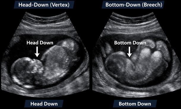 Fetal Position Ultrasound Comparison