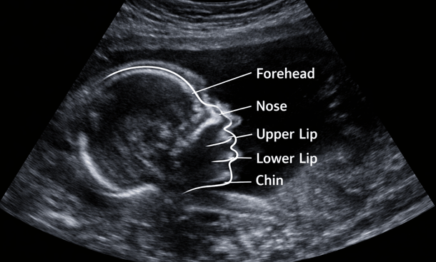 Perfect Fetal Profile