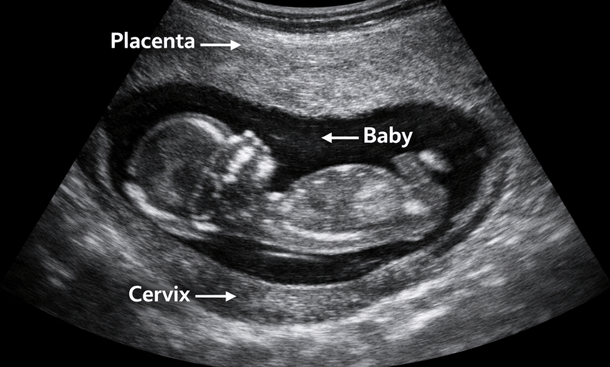 Placenta Ultrasound Guide