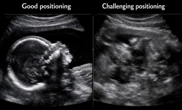 Ultrasound Positioning Comparison
