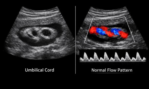 Umbilical Cord Blood Flow