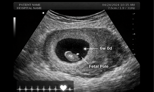 Early Ultrasound Embryo